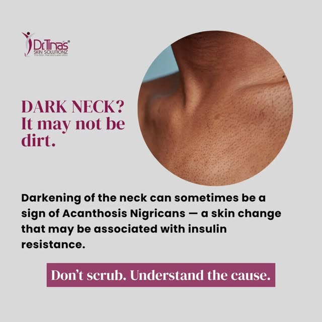 Dark neck doesn’t always mean poor hygiene.

A condition called Acanthosis Nigricans can cause the s