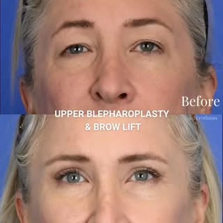 Endoscopic Brow Lift and Upper Blepharoplasty at 1.5 months post op😀 A natural brow lift and upper 