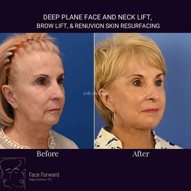 8 months post-op, she’s looking beautifully refreshed after her Deep Plane Face & Neck Lift, Brow Li
