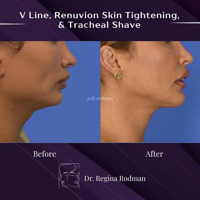 Lower Face Transformation: ✨Genioplasty, Vline Surgery, Renuvion Skin Tightening + Tracheal Shave | 