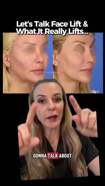 Glamour No Fluff... Does a Deep Plane Face Lift help lift the cheeks? Dr. Rodman explains🎙️

Intere