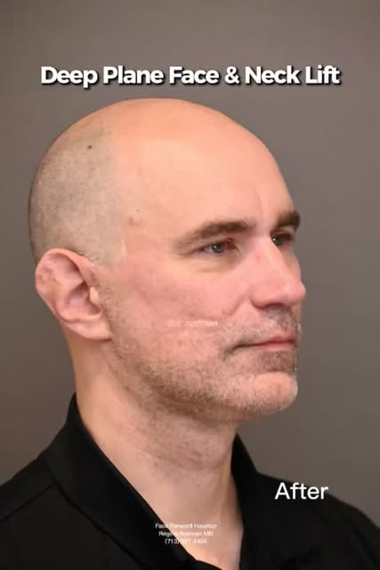 Do men get facelifts?  YES!  MALE DEEP PLANE FACE AND NECK LIFT at 10 months post op!💫 This patient