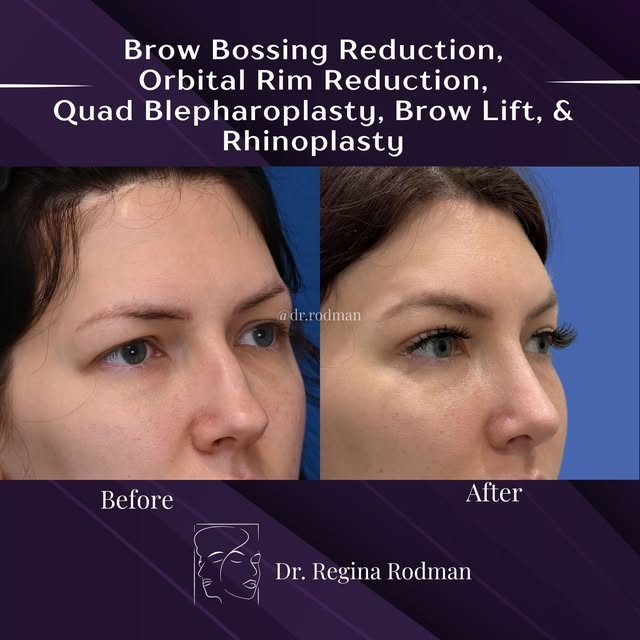 This lovely patient came in looking to soften her facial features. She had a previous browlift elsew