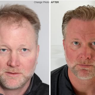 No gimmicks. Just real growth.

Our patient is 13 months out from 3550 FUE grafts and is super thril