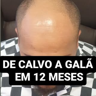 O transplante capilar já é uma realidade atual. Considerada uma solução definitiva para a queda capi