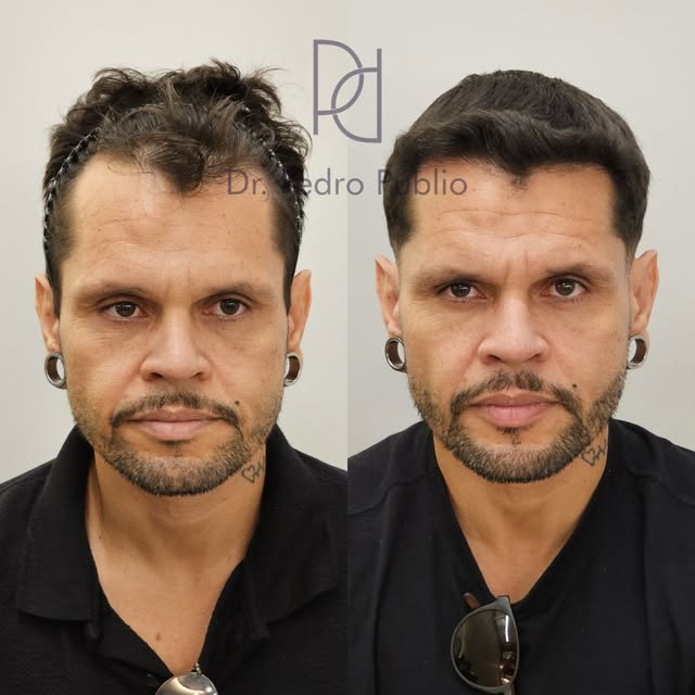 Evolução pós-operatória de paciente submetido ao transplante capilar pela técnica FUE.

Paciente dia