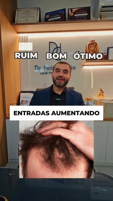 Siga @dr.pedropublio 

#transplantecapilar #cabelo #calvicie #quedadecabelo #saúdecapilar
