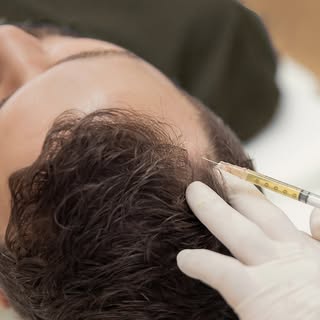 Scalp PRP (Platelet-Rich Plasma) therapy uses your body’s own growth factors to naturally stimulate 