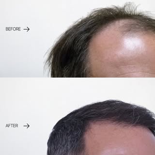 Real results, real confidence.

Our patient’s transformation says it all—natural density, restored h