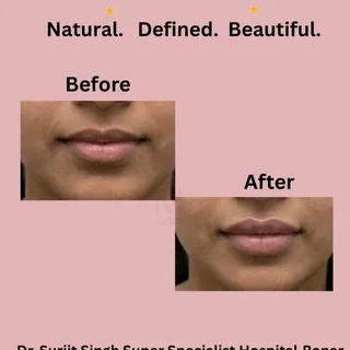 Your lips, but better 💋 Natural-looking lip filler that enhances your natural shape — no duck lips,