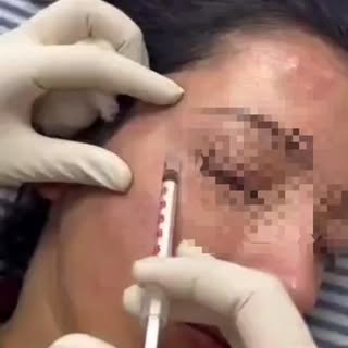“Wondering why your Botox fades early? 👀

These habits could be the reason:
❌ Early workouts
❌ Heat