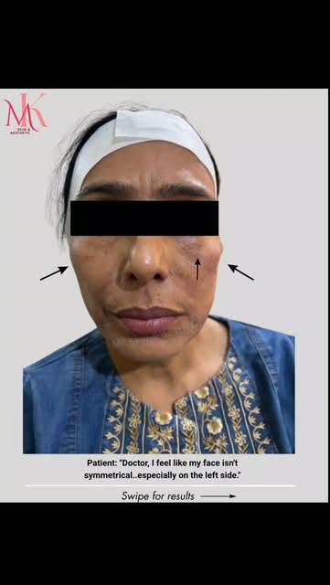 ✨ Sometimes, it’s not about changing your face — it’s about restoring balance.

My patient came in w