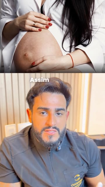 A queda de cabelo no pós-parto é comum e, na maioria das vezes, passageira. É o corpo se reajustando