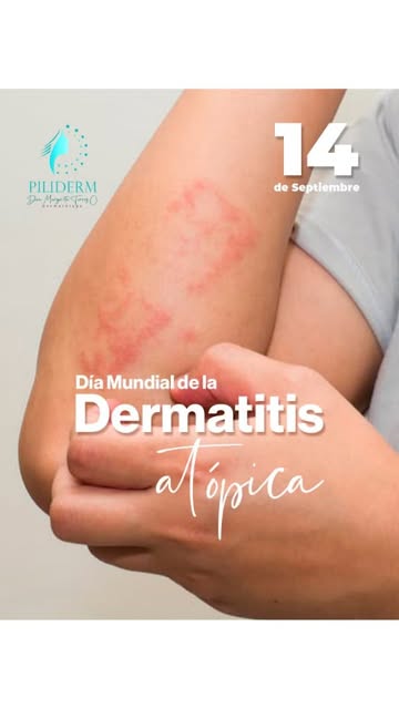 Este 14 de septiembre, Día Mundial de la Dermatitis Atópica 💙🌿 recordamos la importancia de cuidar