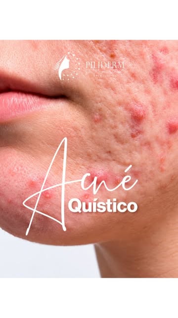 🚨 ¿Ese granito grande, duro y doloroso no desaparece? No lo aprietes. Puede tratarse de acné quísti