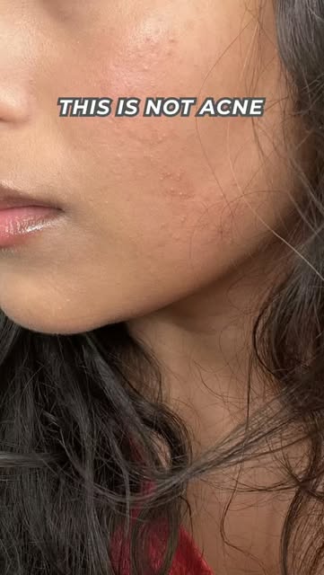 Those tiny bumps aren’t always acne. 👀

Not every bump, dot, or “whitehead” on your skin needs to b