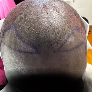 Performing FUE (Follicular Unit Extraction) on Afro-textured hair is more complex than on straight o