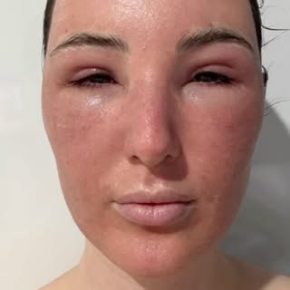 CO2 laser resurfacing looks a little intense but the feedback from all patients is that it’s much ea