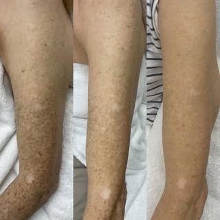 Trust The Process ✨

We treated this patient with our medical grade IPL. These are the results after
