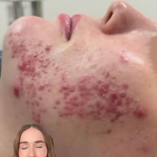 A 10 week journey in clinic for someone who presents with acne. Our aim is rapid treatment for the a