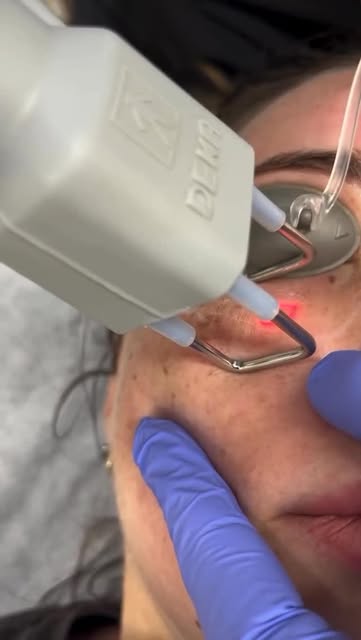 CO2 FRACTIONAL LASER 👁️👁️
Combine this with Rejuran

Laser resurfacing is a specialised skin treat