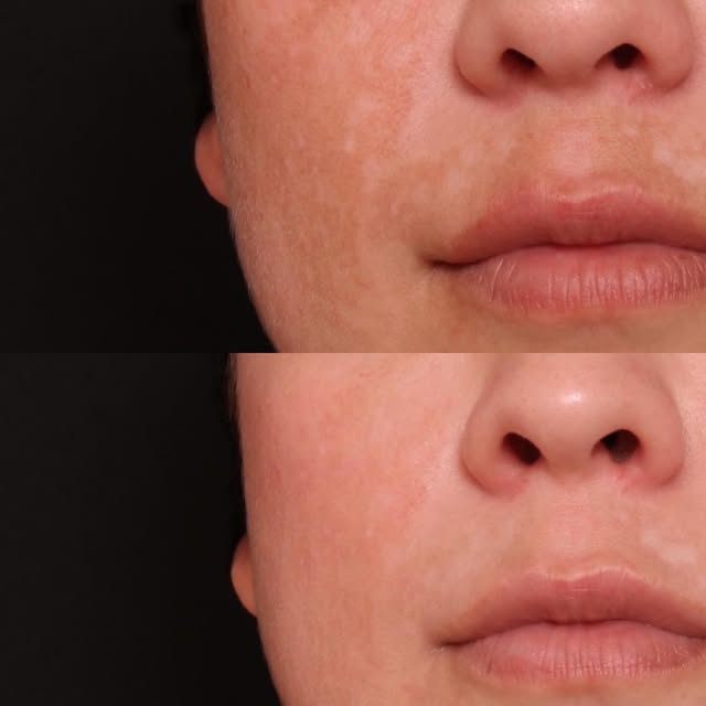 Treating Melasma 💫