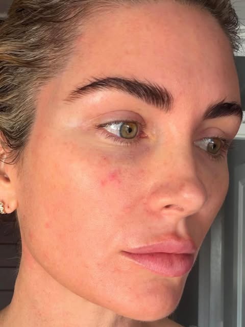 Day 1 after full face PICOSURE PRO laser treatment 💥

The Picosure Pro shatters pigmentation with u