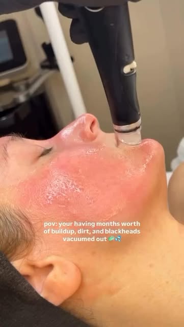 Clogged, textured, or tired skin? Consider this your sign to book a Hydrafacial. Your glow is waitin