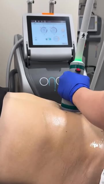 The 3 in 1 effect with Onda Coolwaves®️ treating Fat, Cellulite, and Skin Laxity ✨

Consultations ar