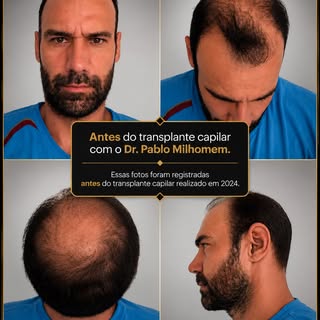 Há casos que impressionam antes mesmo do primeiro enxerto.

Este paciente apresentava um quadro de a
