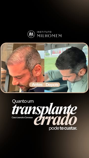 Acompanhe o caso do nosso paciente Leandro Canassa, que, insatisfeito com o resultado de um transpla