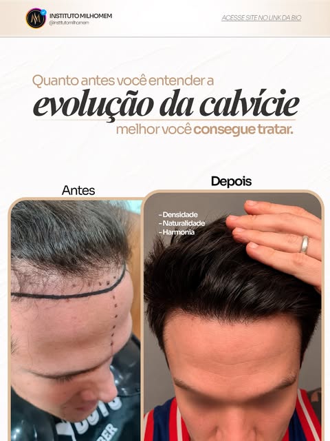 Calvície não aparece de um dia pro outro. Ela avança aos poucos: primeiro as entradas, depois a linh