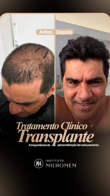 Veja dois casos de pacientes em que conciliamos o tratamento clínico com o transplante capilar e com