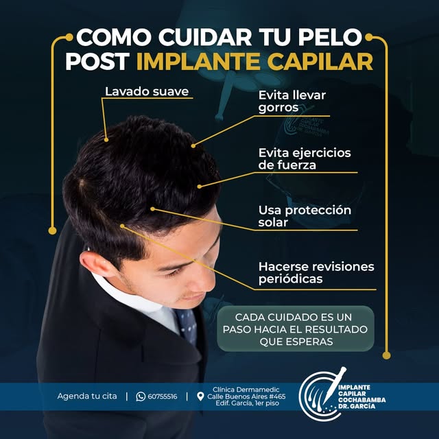 💈 El procedimiento es solo una parte del camino.

Después de un implante capilar, seguir correctame