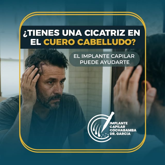 Las cicatrices en el cuero cabelludo pueden ser consecuencia de una cirugía, un accidente o una lesi