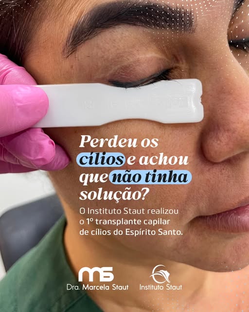 Cílios também podem ser reconstruídos por meio do transplante capilar.

Para quem perdeu os fios de 