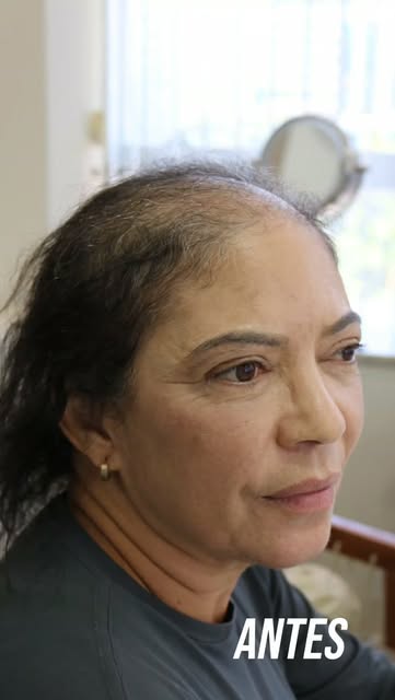 ✨️Transplante Capilar FUE feminino: um antes e depois que representa muito mais do que novos fios.✨️