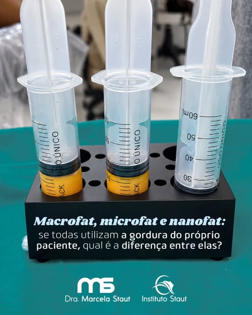 Sempre explico aos meus pacientes que a gordura autóloga é um tecido muito precioso, pelas inúmeras 