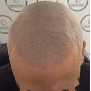 Oakwell Clinic has been Bringing Hairlines Back since 2020. What are YOU waiting for?.. Get in touch