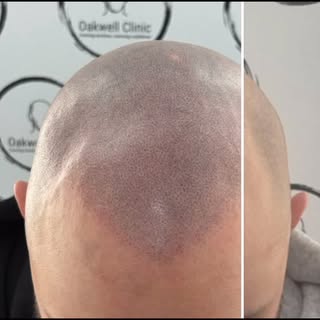 Another amazing transformation for this great guy. We have the best clients at Oakwell Clinic. Get i