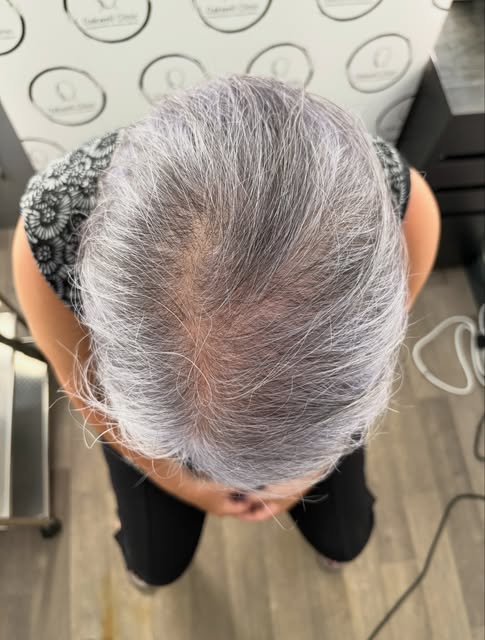 I only take on specific clients for density treatments as there are usually more factors to consider