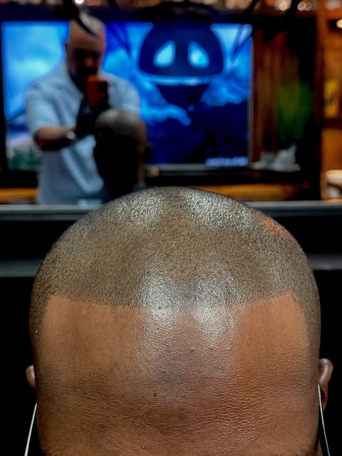 Is your hairline receding? Scalp micro pigmentation can restore your hairline with no down time. Loo