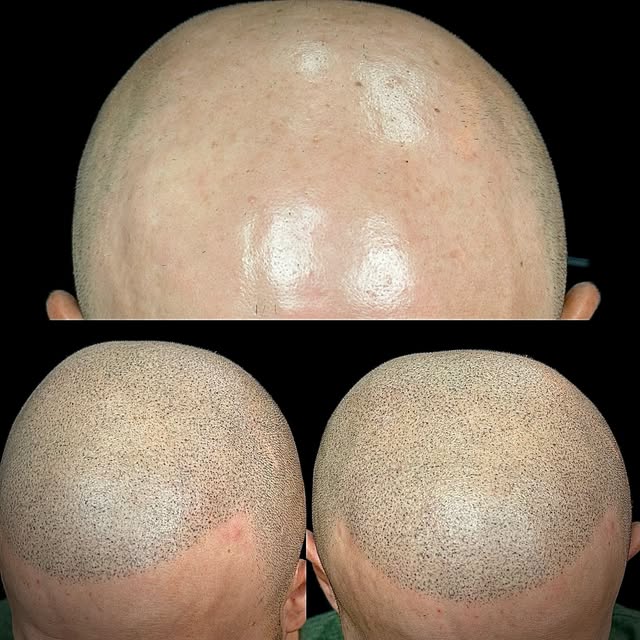Looking for a hair loss solution with no down time ? Scalp micro pigmentation can help. Call us at 9