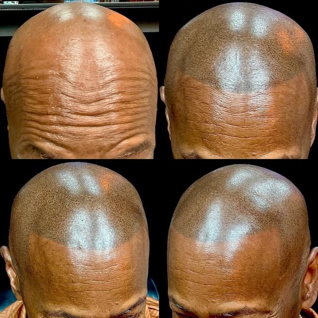 Fast affordable hair loss salutation with scalp micro pigmentation! Having your hair line restored w