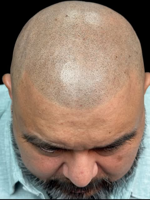 Hair loss salutation in hours ! Scalp micro pigmentation is fast becoming the number one choice for 
