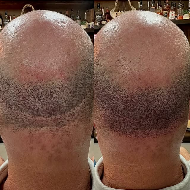 1sr session results covering up a hair transplant scar with scalp micro pigmentation. SMP is designe