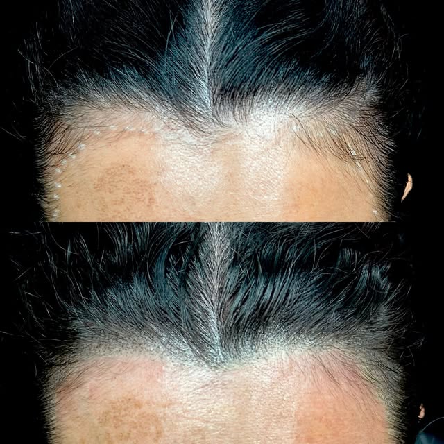 Women’s hair line restoration with scalp micro pigmentation. Confidence restored with a minor SMP se