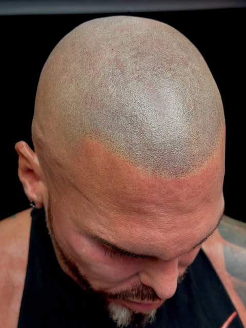 Looking to get your SMP treatment redone? Call me to see if we can redesign your hairline and correc