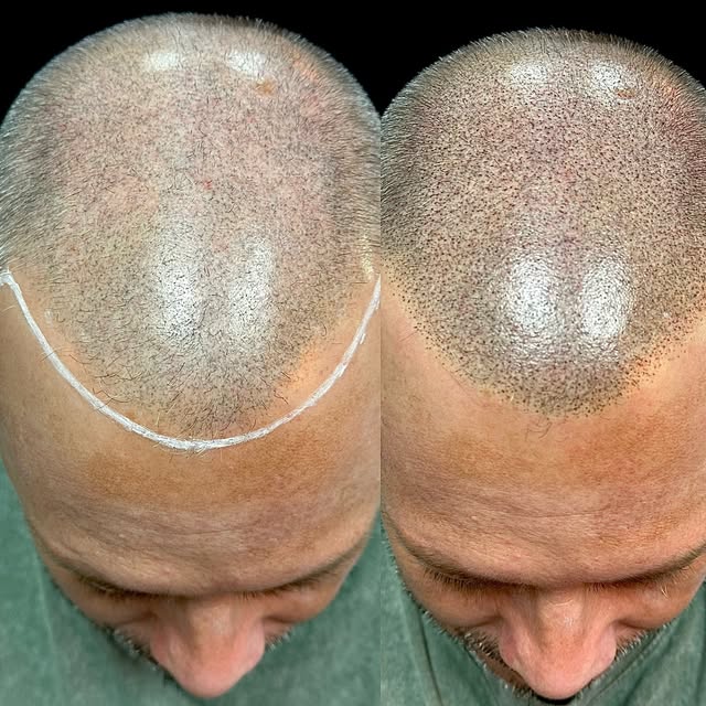 Hairline adjustment and density Treament with scalp micro pigmentation. Fast affordable solution to 
