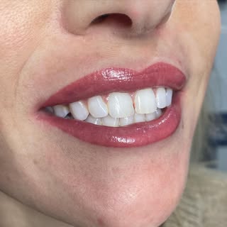 The smile says it all 🥰🤩 this beautiful lady went to get fillers and was told no filler would come